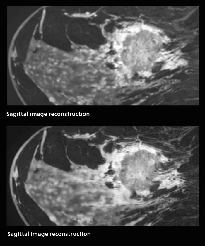 Fast AI-enabled MRI of breast cancer: comparing 3D acquisitions with 0.75 mm and 0.6 mm isotropic voxels, mobile two
