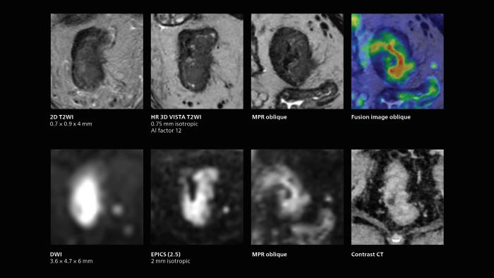 MRI of rectal cancer: fast isotropic 3D acquisitions providing excellent image quality with use of AI-enabled SmartSpeed